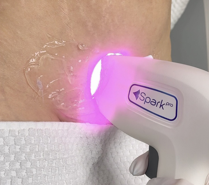 Laserhandstück wird auf der Haut angewendet, Behandlung mit Gel und Handschuh, dauerhafte Haarentfernung in Leverkusen.